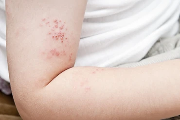 Over 50? Get that shingles shot  image