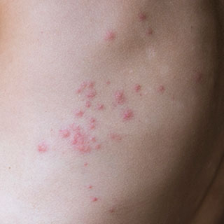 What Do Bedbug Bites Look Like? (2024) | ConsumerAffairs®