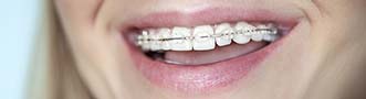 Average Cost Of Braces 2024 Cost Comparison Study ConsumerAffairs   Ceramic Braces Small 