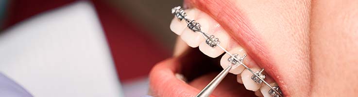 The Average Cost of Braces per Month - Egger Orthodontics