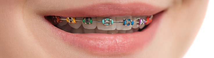 LOW COST Braces From $3,900 in Mississauga