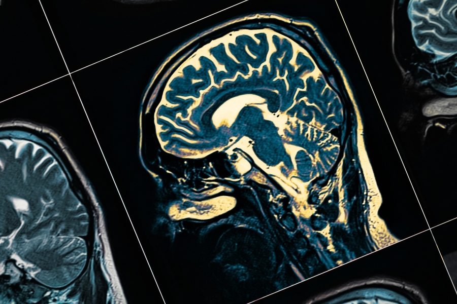 Aluminum in brain tissue could increase risk for familial Alzheimer's