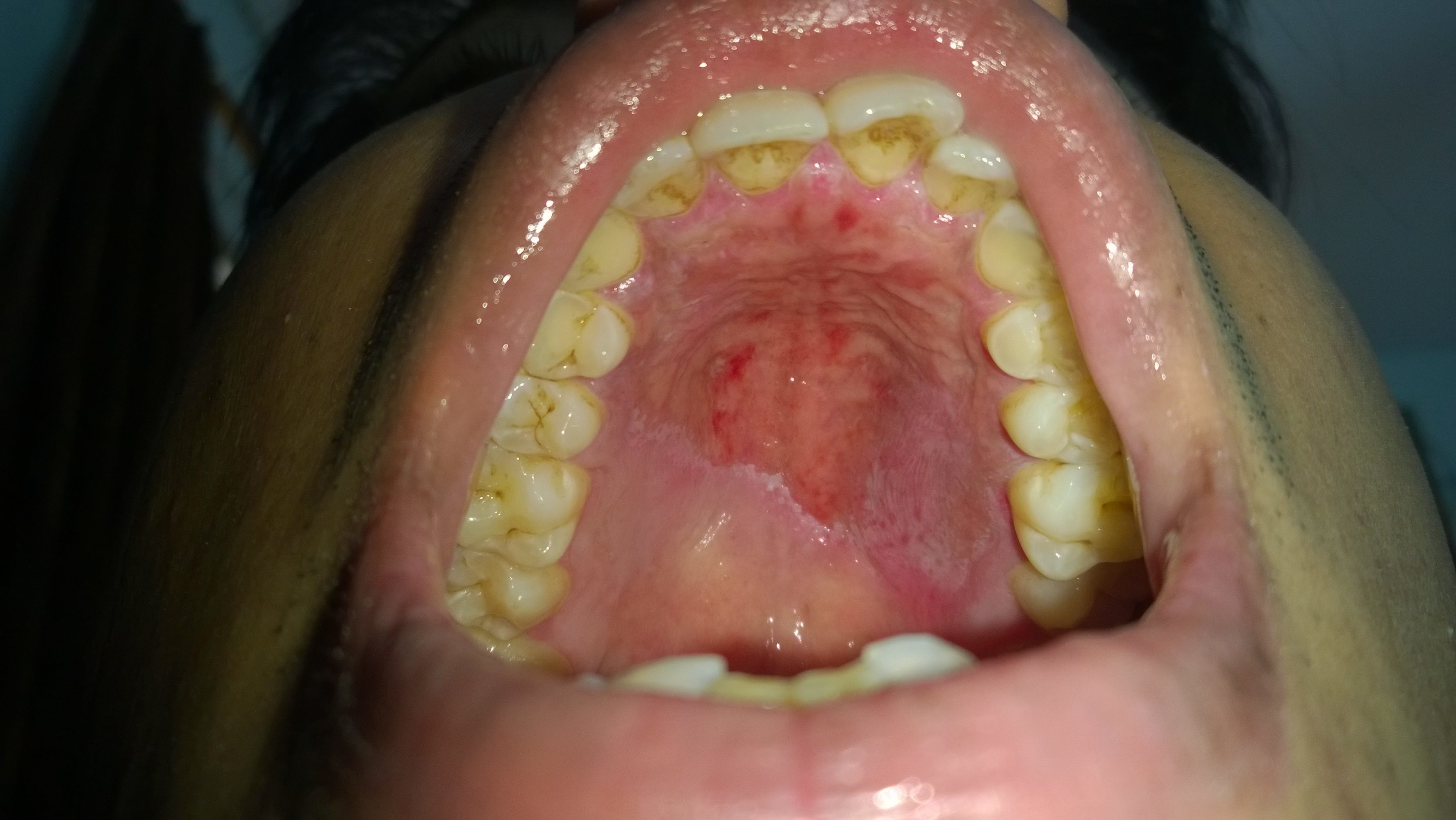 sore inside mouth