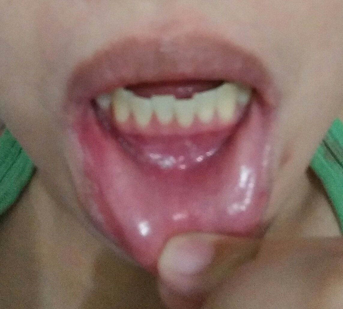Black spot on inner lip, what could it be? | Yahoo Answers