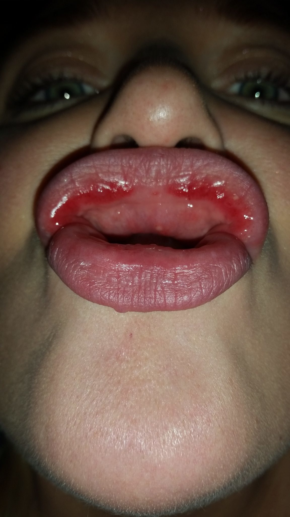 Redness Inside Mouth 63