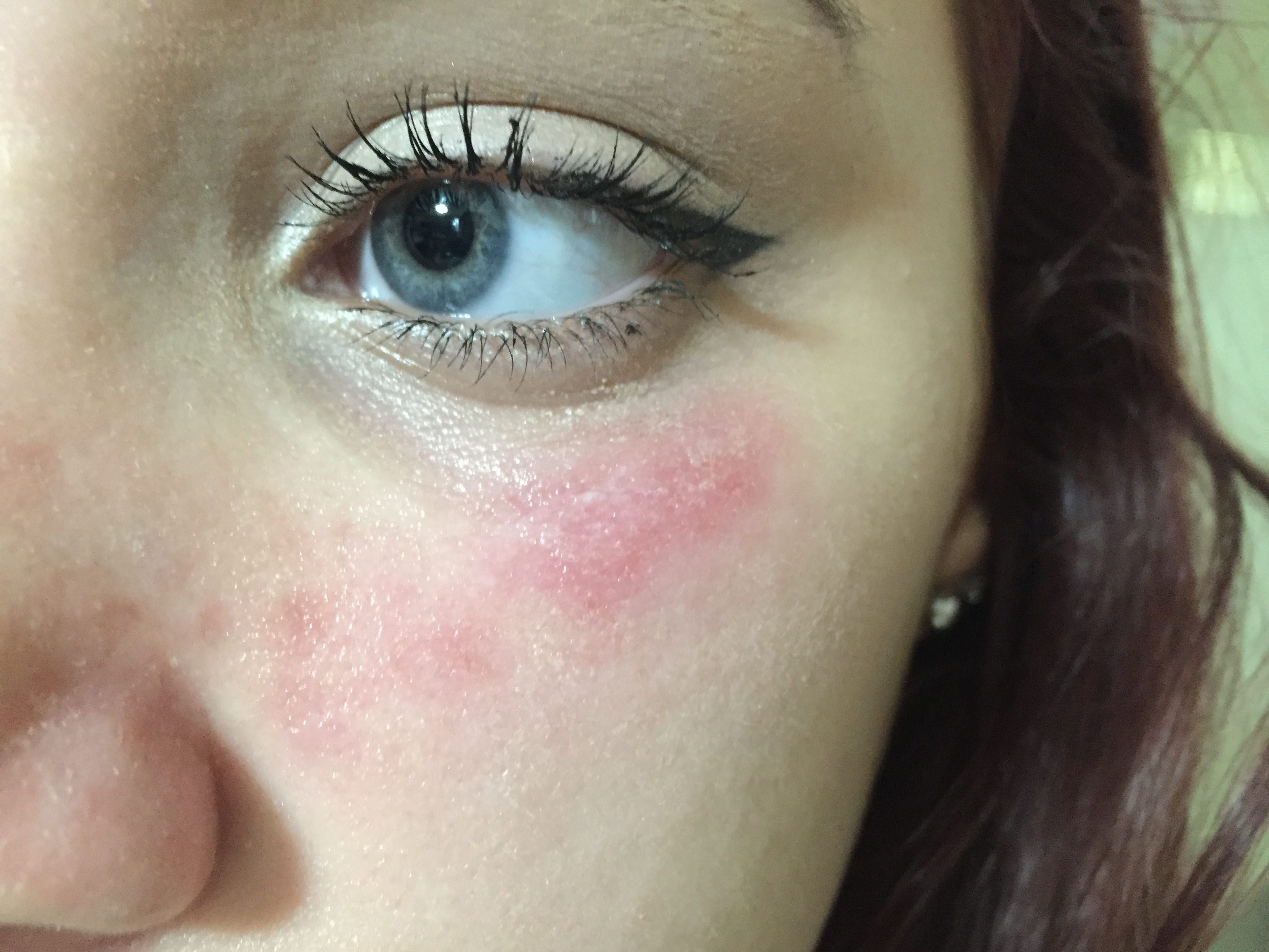 Allergic Reaction To Makeup Around Eyes Saubhaya Makeup