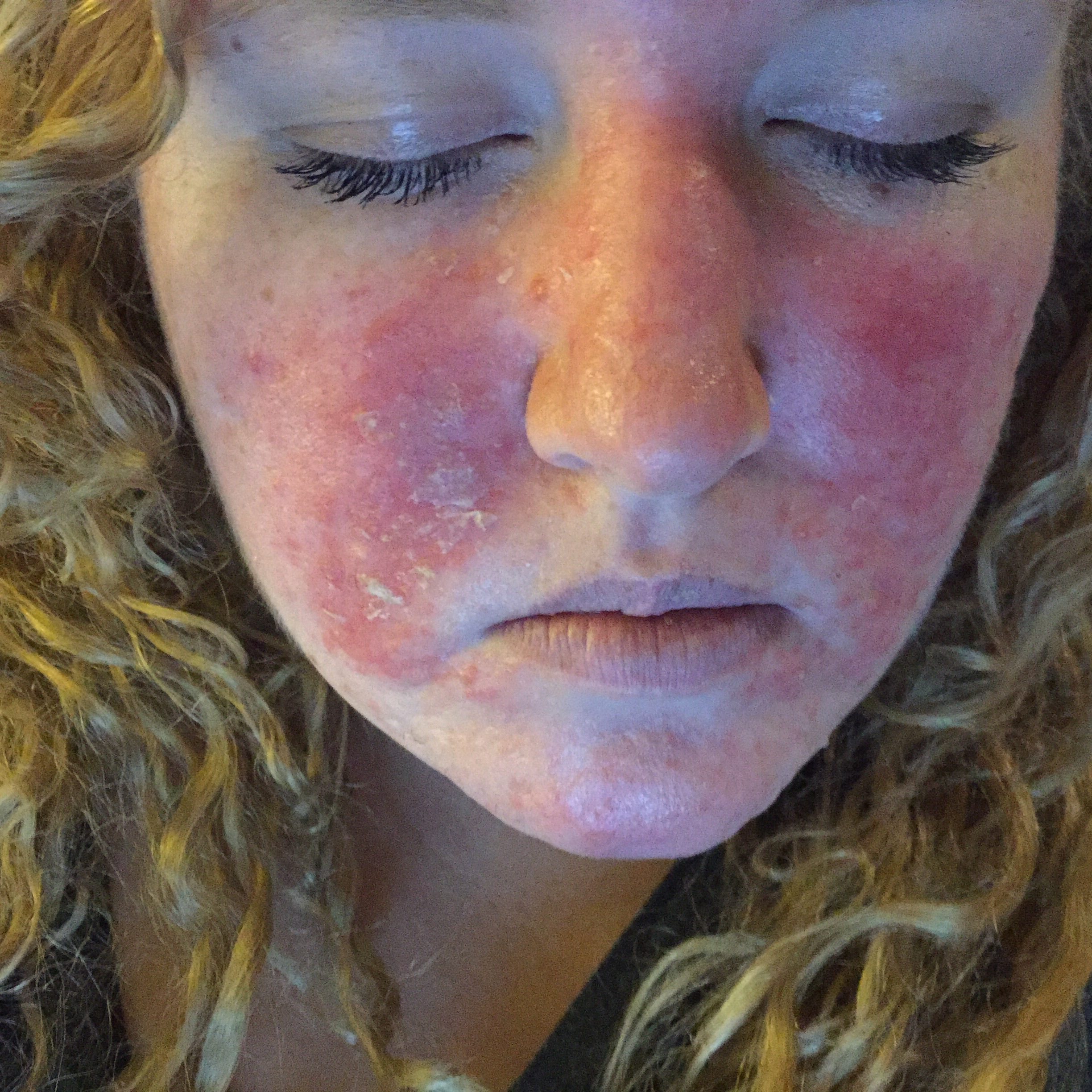 chemical burn from face wash