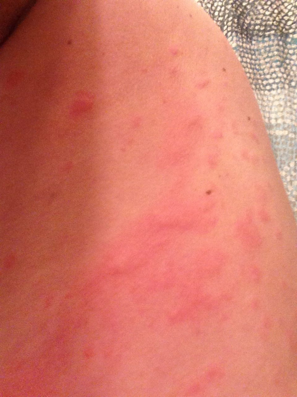 prednisone rash